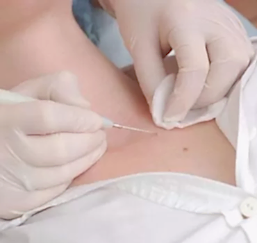 Удаление папиллом Удаление папиллом