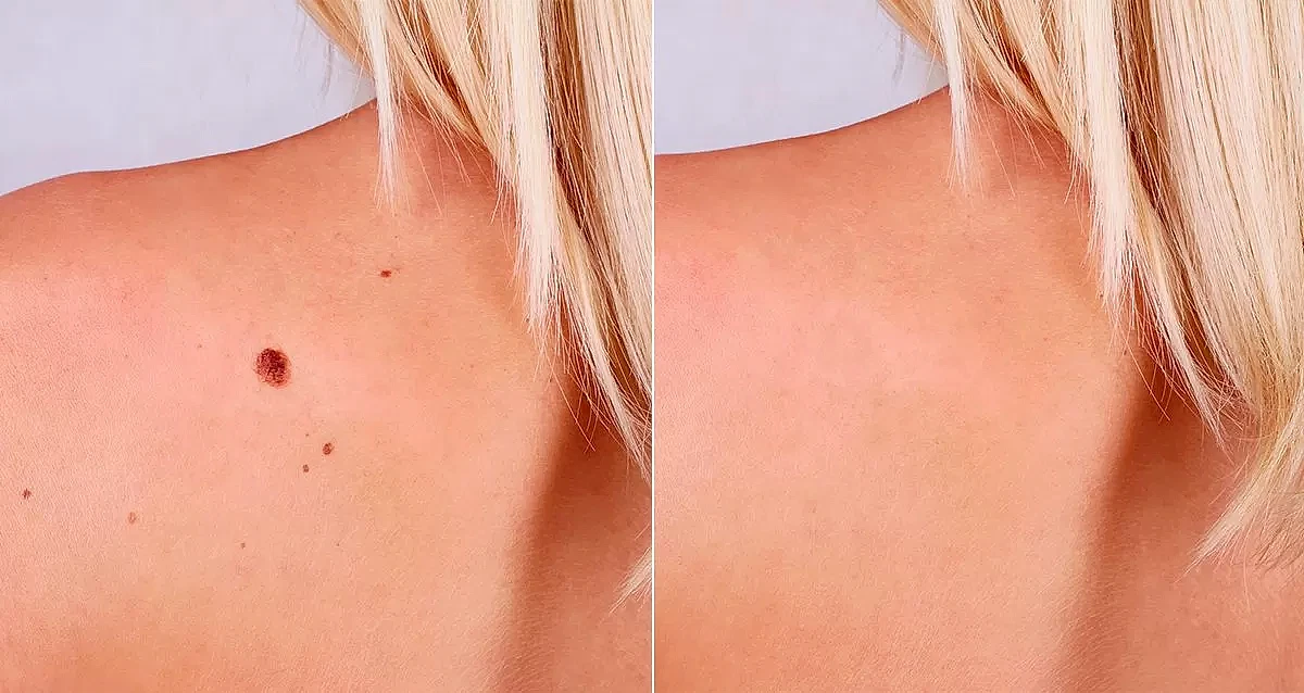 Удаление новообразований