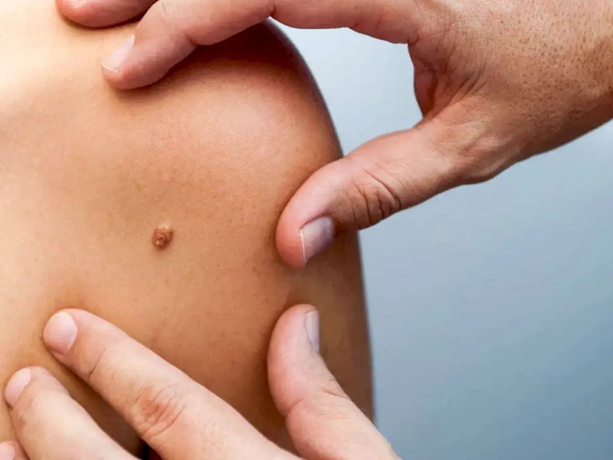 Как отличить это папиллома или бородавка?