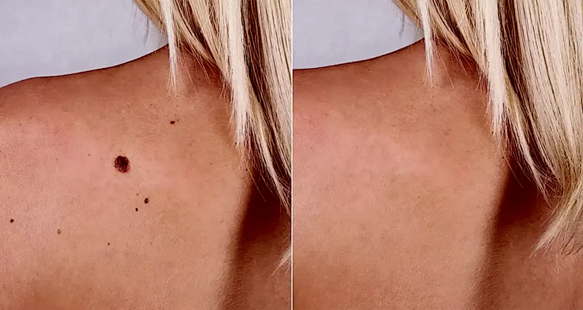 Удаление родинок Удаление родинок