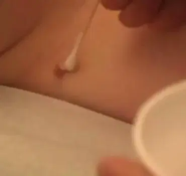 Удаление бородавок