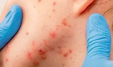 Избавиться от прыщей и угрей. Избавиться от прыщей и угрей.