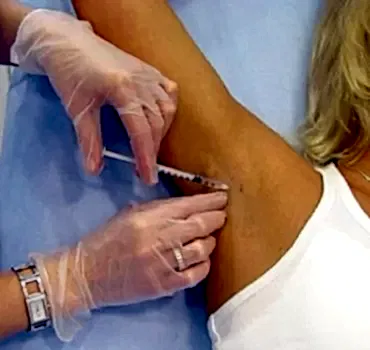 Лечение повышенного потоотделения