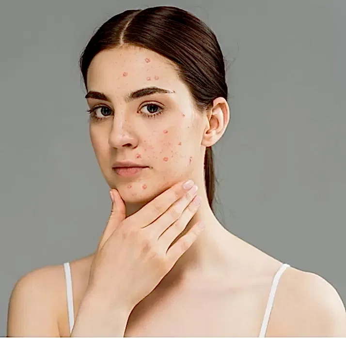 Избавиться от прыщей и угрей