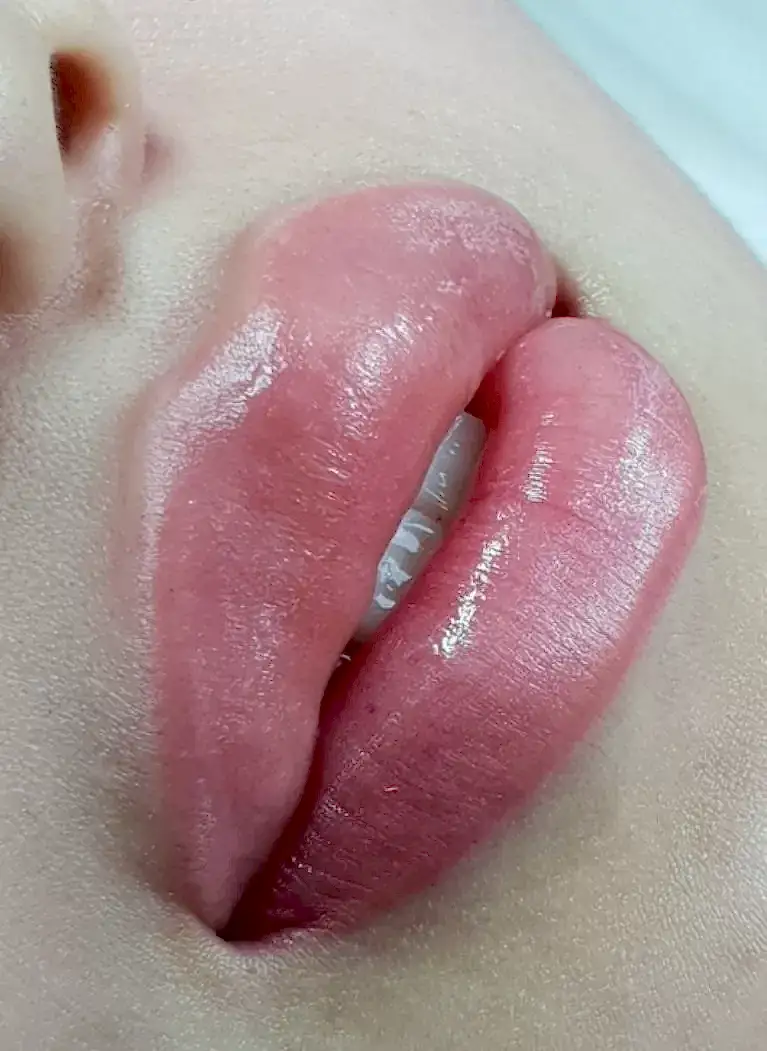 Увеличение губ Увеличение губ