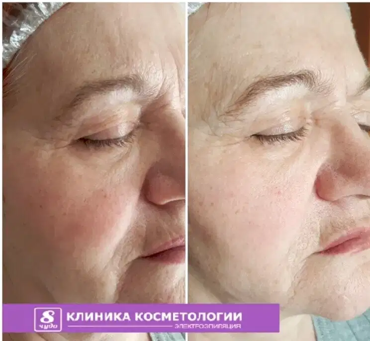 Контурная пластика 02.jpg Контурная пластика 02.jpg