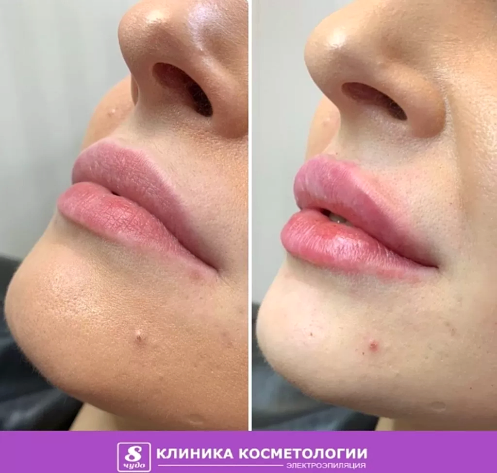 Чемакина Я.Г. Увеличение губ.jpg Чемакина Я.Г. Увеличение губ.jpg