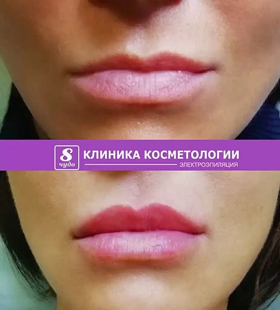 Полякова Т.Г. Увеличение губ (2).jpg Полякова Т.Г. Увеличение губ (2).jpg