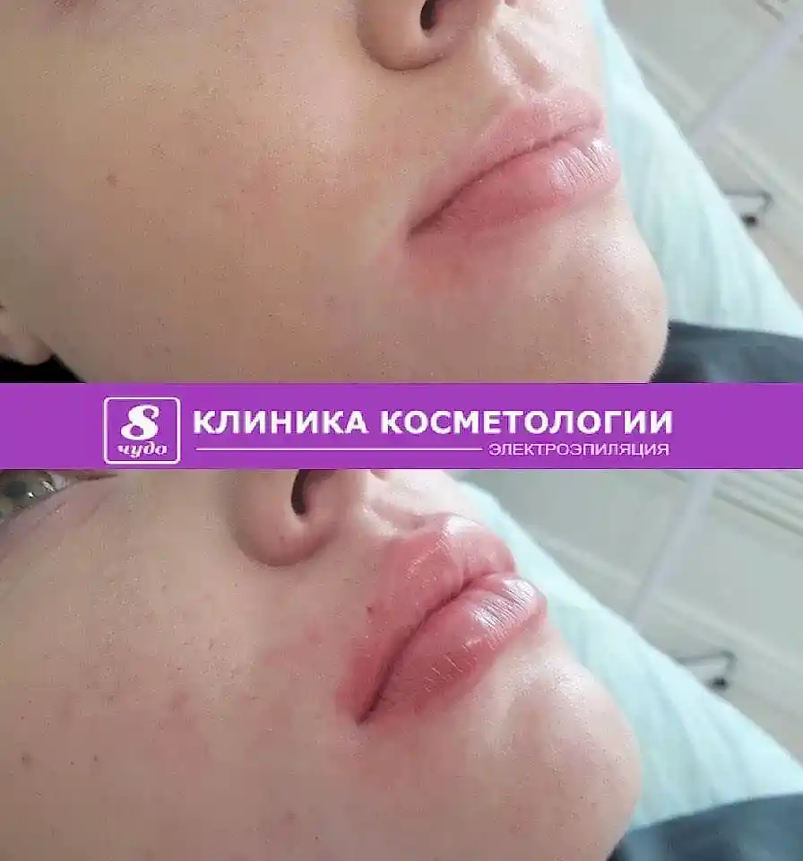 Увеличение губ 01.jpg Увеличение губ 01.jpg