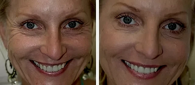 botulinoterapija-preparatom-disport.jpg botulinoterapija-preparatom-disport.jpg