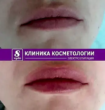 Увеличение губ 11.png Увеличение губ 11.png