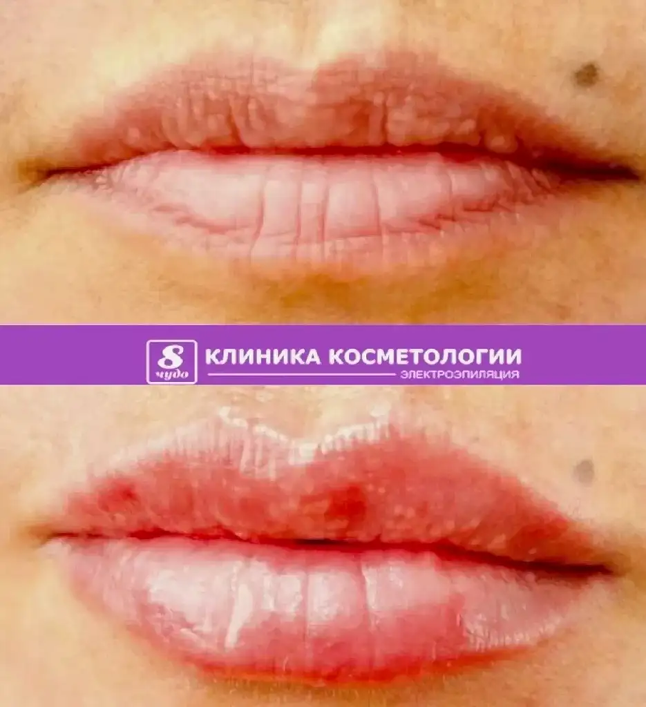 Ломова Н.В. Увеличение губ.jpg Ломова Н.В. Увеличение губ.jpg