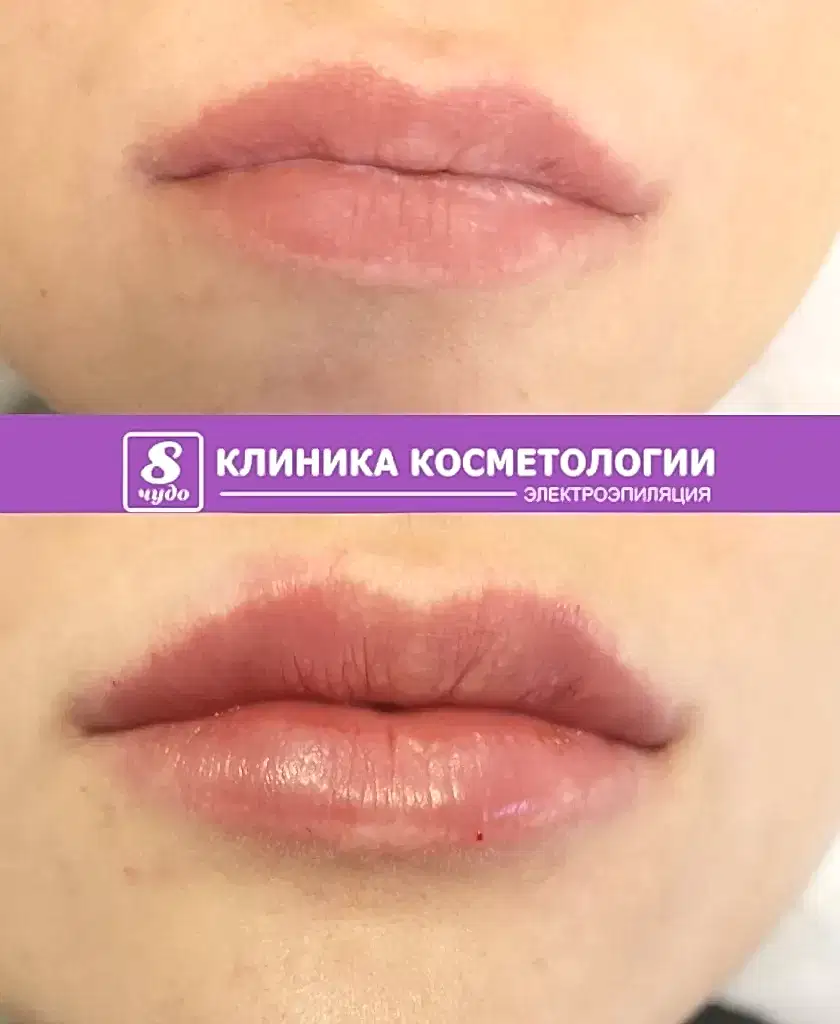 Полякова Т.Г. Увеличение губ (1).jpg Полякова Т.Г. Увеличение губ (1).jpg