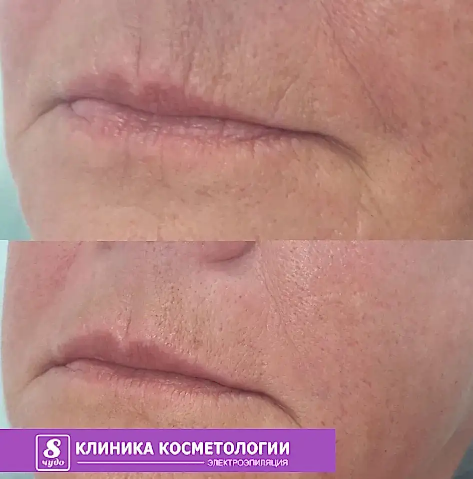 Контурная пластика.jpg Контурная пластика.jpg