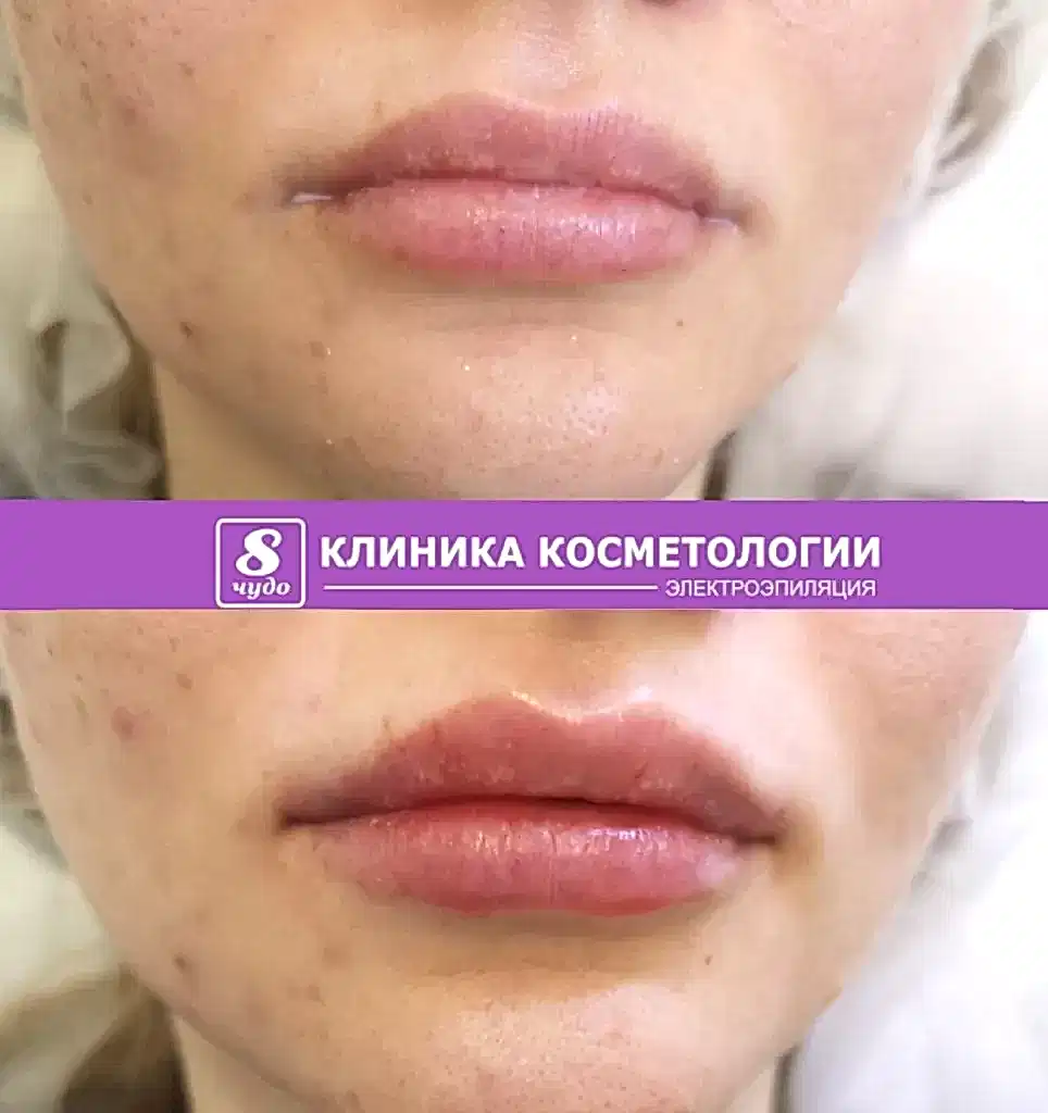 Полякова Т.Г. Увеличение губ (4).jpg Полякова Т.Г. Увеличение губ (4).jpg