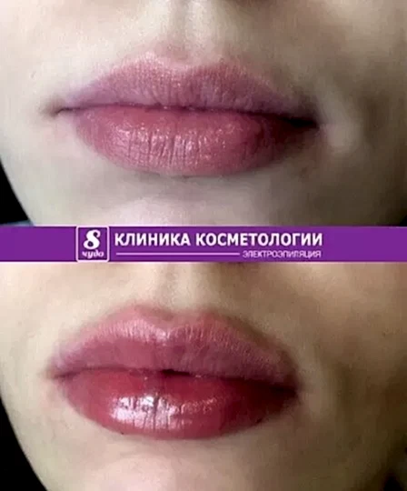 Увеличение губ 55.jpg Увеличение губ 55.jpg